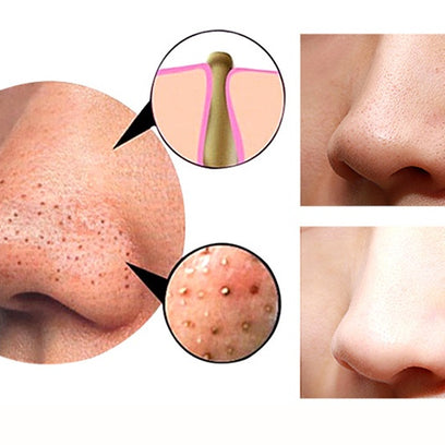Facial Blackhead Remover