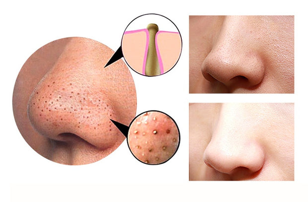 Facial Blackhead Remover